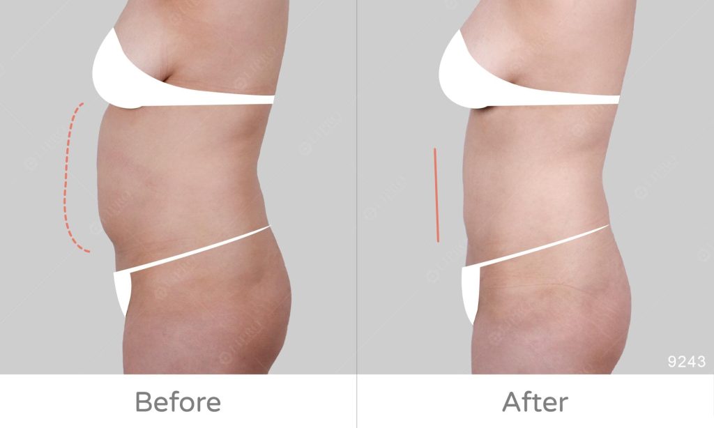 麗波永康抽脂腹部案例，腰腹抽脂術前術後反差對比