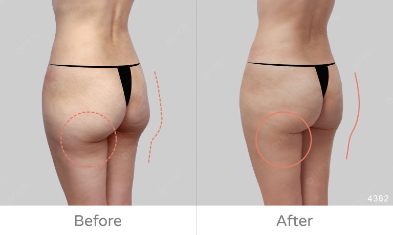 顯微套管臀部精緻抽脂、臀腿抽脂案例分享，下半身曲線美感升級