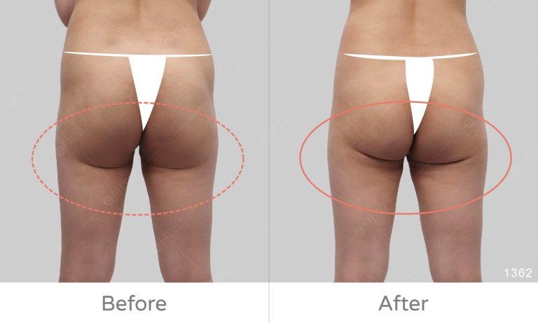 臀腿抽脂修飾臀線術後成果，下垂臀線微笑線修復拯救案例
