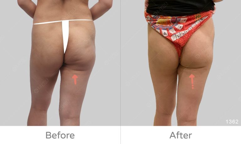 顯微套管修復拯救臀部抽脂案例，臀部微笑線精緻化處理術後成效
