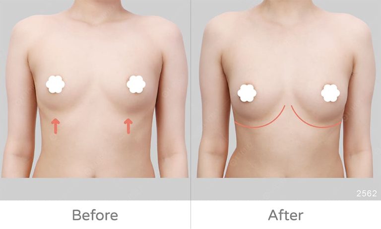 避免假體隆乳副作用，自體脂肪隆乳新選擇，麗波永康國際診所豐胸案例好評