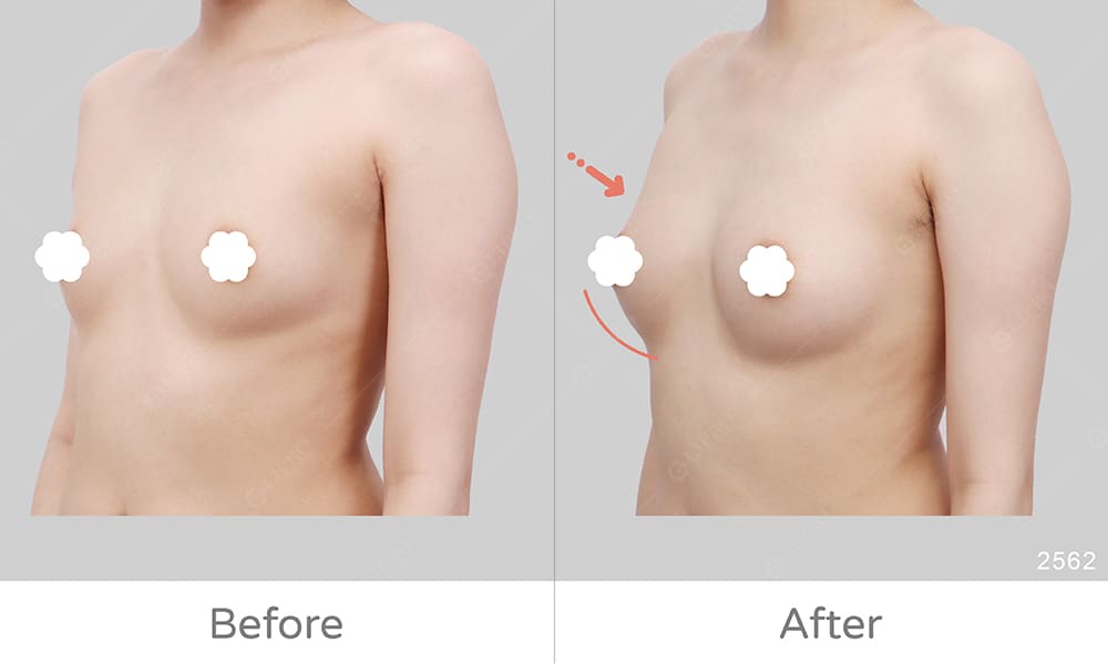 自體脂肪豐胸案例術後成效真實呈現，側面45度角展現術前術後差異