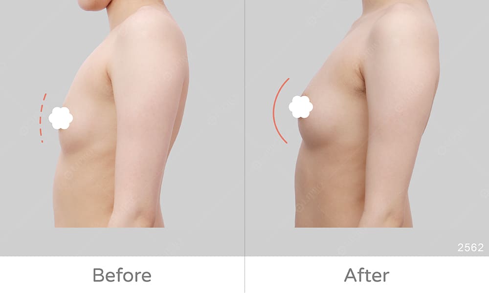 豐胸案例手術前後差異靈修圖真實呈現，顯微套管豐胸案例好評