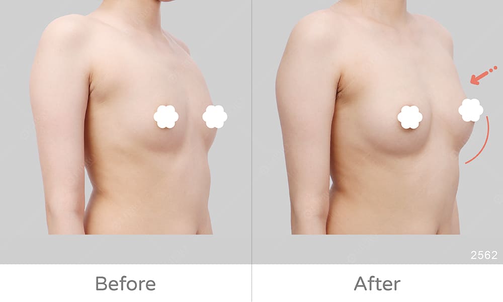 麗波永康國際診所自體脂肪豐胸案例術前術後差異真實呈現
