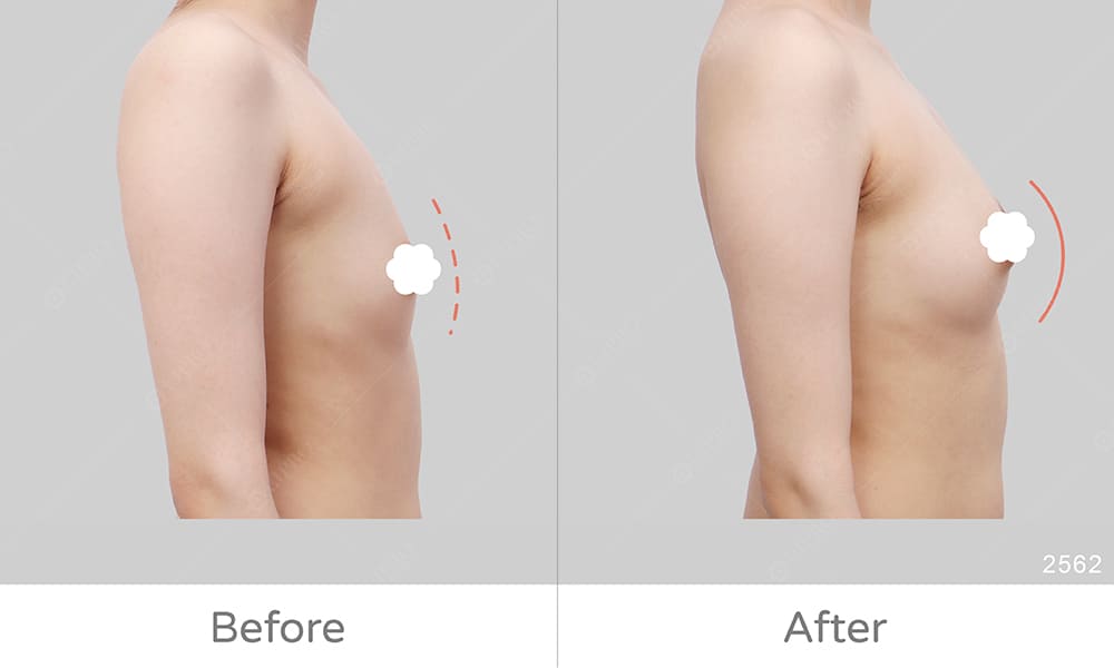 顯微套管豐胸案例好評、側面展示自體豐胸術後成效，麗波隆乳案例評價