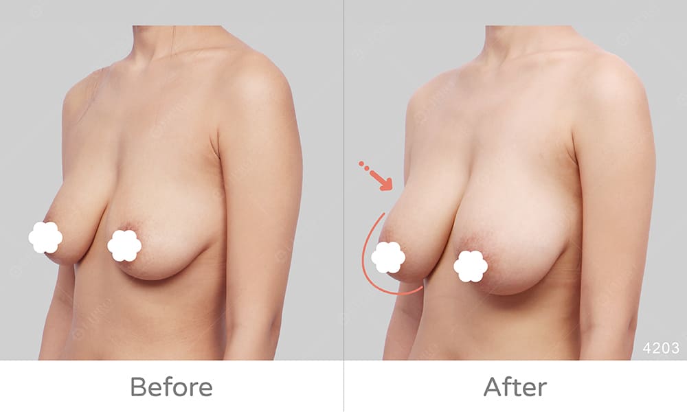 顯微套管自體脂肪豐胸BA、產後鬆弛案例術後成效示意