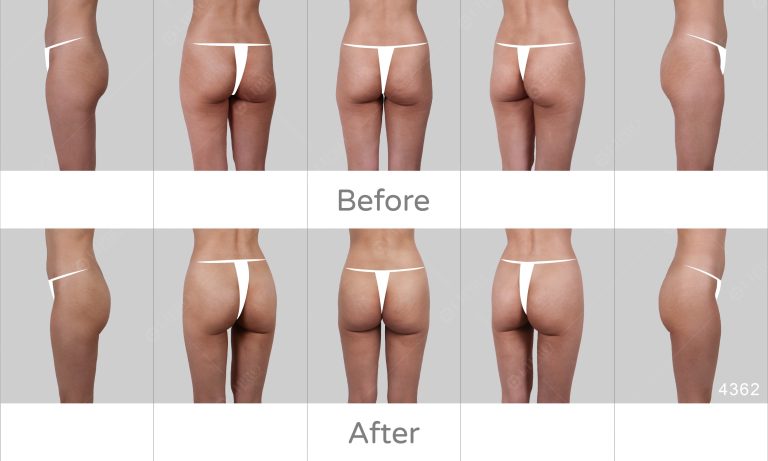 五種角度展示臀部抽脂術後成效，顯微套管抽脂臀部案例