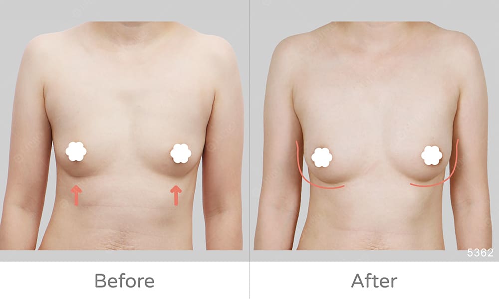 顯微套管抽脂自體豐胸案例分享，正面角度呈現豐胸手術案例成效