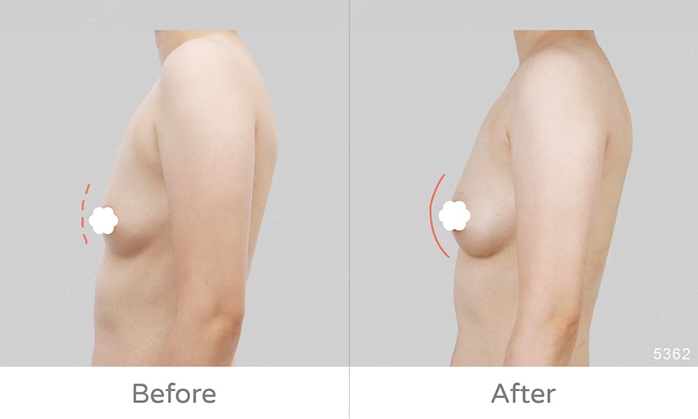 自體豐胸案例分享，側面90度角呈現豐胸手術案例成效