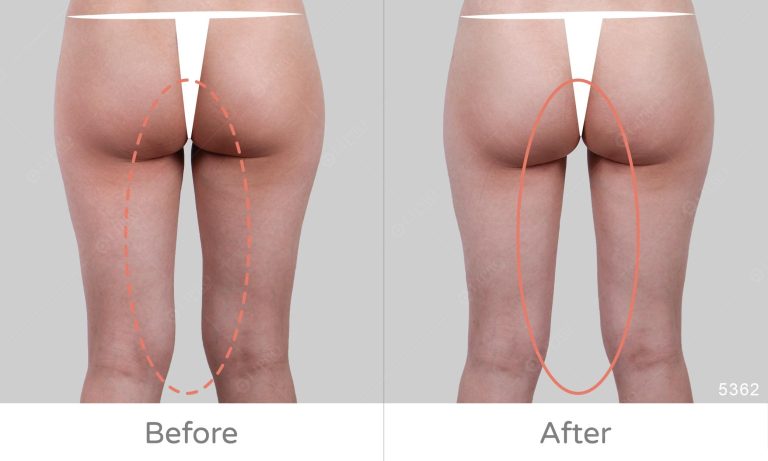 顯微套管大腿抽脂案例分享，內側曲線調整後更顯瘦