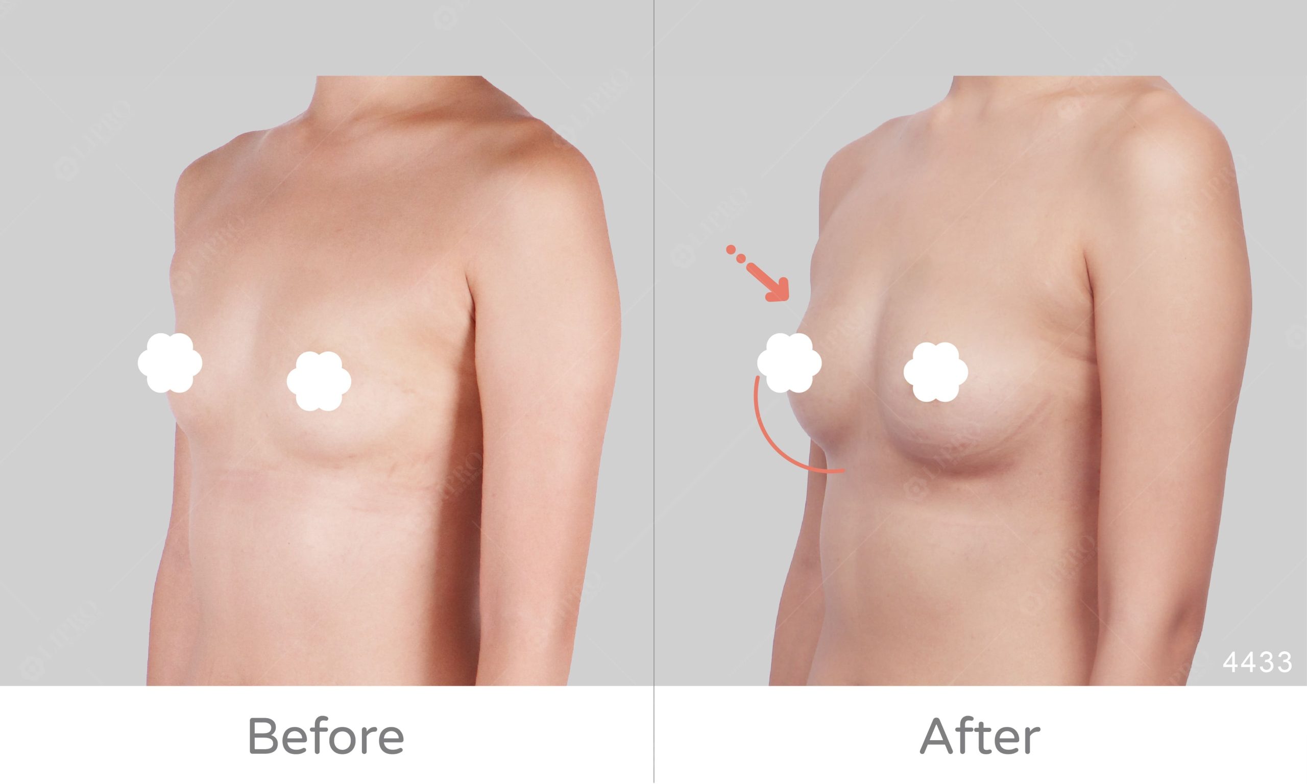 豐胸評價、自體脂肪豐胸案例見證，麗波永康國際診所豐胸案例