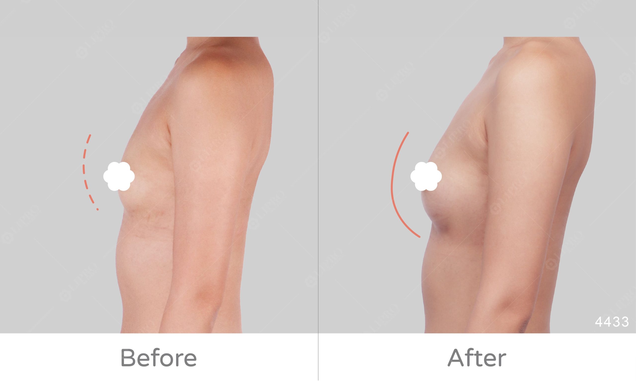 顯微套管抽脂自體脂肪豐胸案例評價，麗波永康豐胸案例術後成效展示