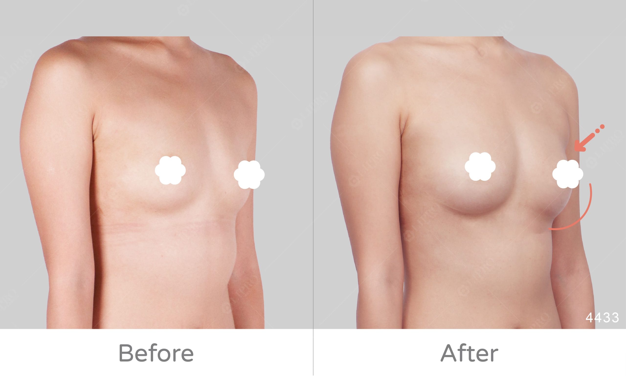 A罩杯自體脂肪豐胸案例，經麗波永康豐胸手術協助，成功擁有美麗胸型