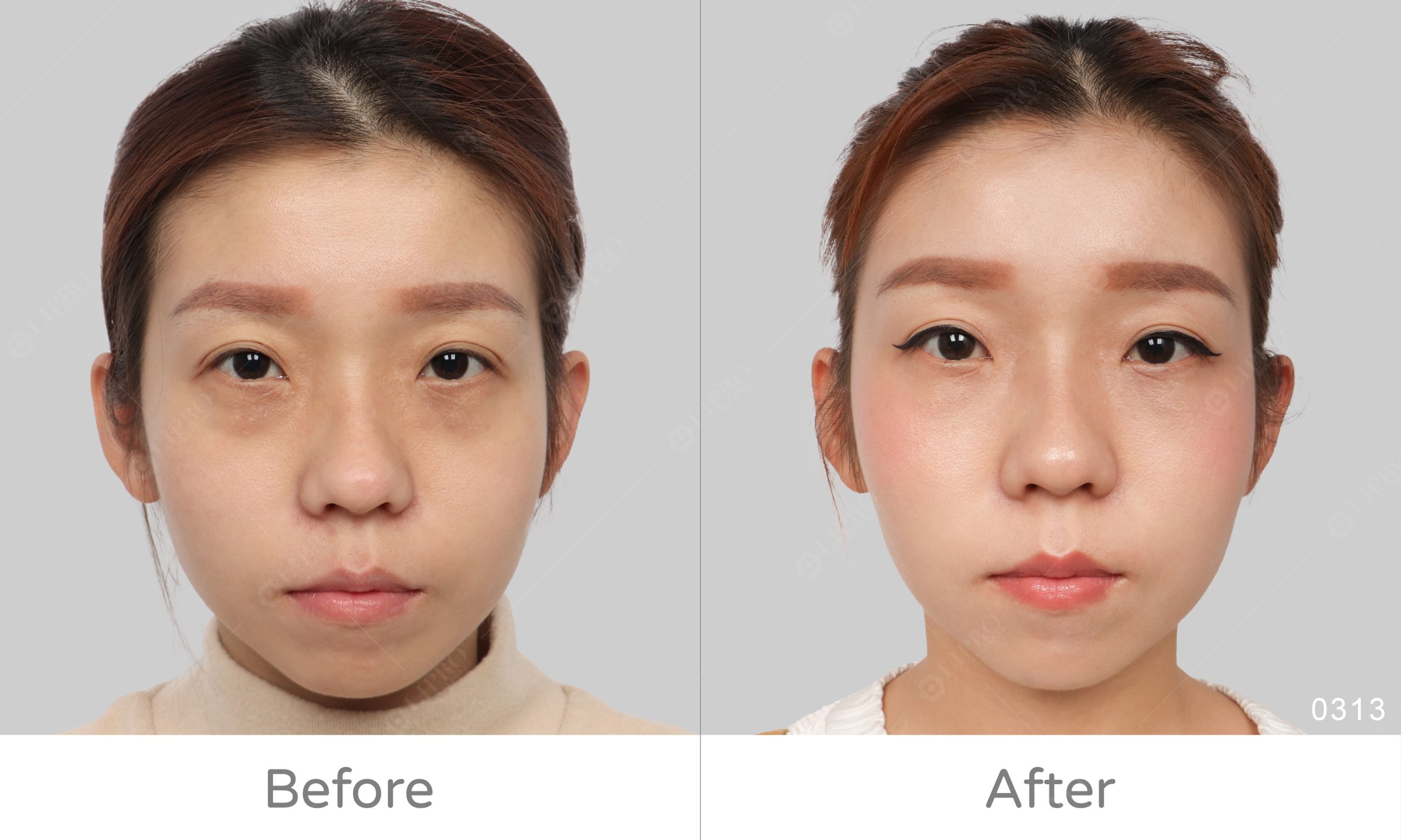 顯微套管精緻全臉補脂，臉部脂肪移植手術案例前後對比