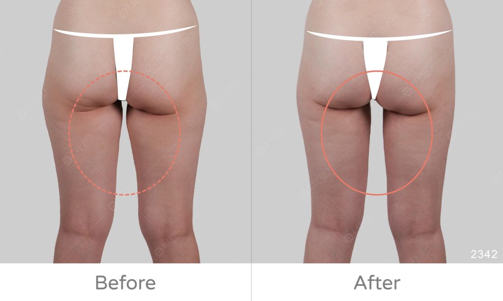 大腿內外顯微套管抽脂案例分享、麗波永康臀腿抽脂專家