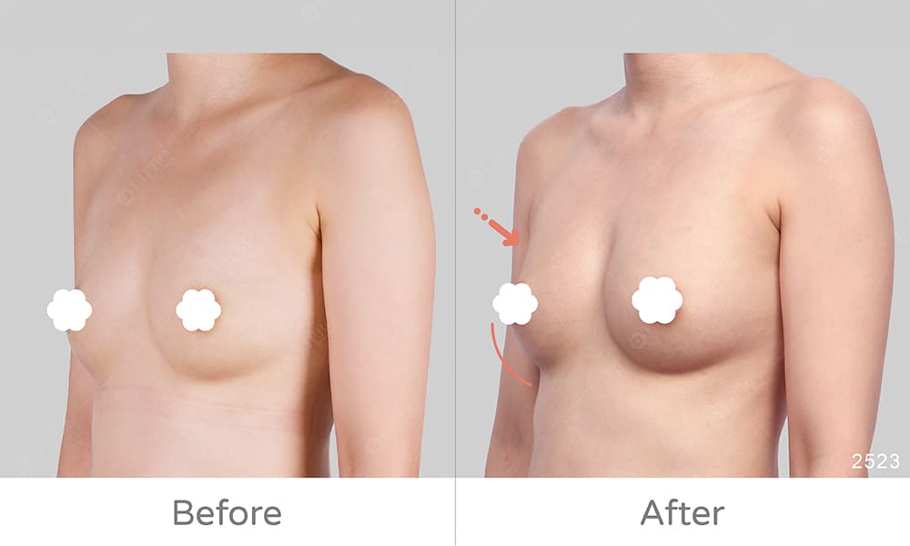 顯微套管自體脂肪豐胸手術優勢:術後免穿塑身衣、恢復快速傷口小