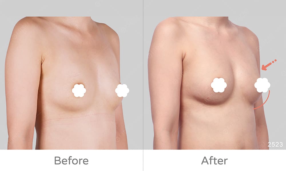自體脂肪豐胸案例、手術前後成效比對圖，麗波永康案例見證