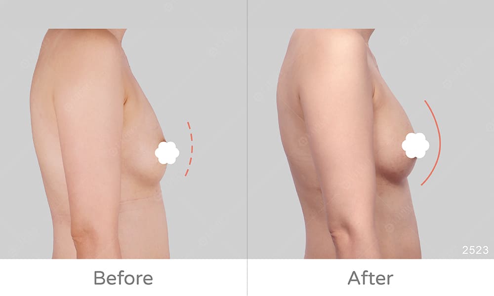 麗波永康自體脂肪隆乳案例見證，顯微套管手術優勢:術後免穿塑身衣
