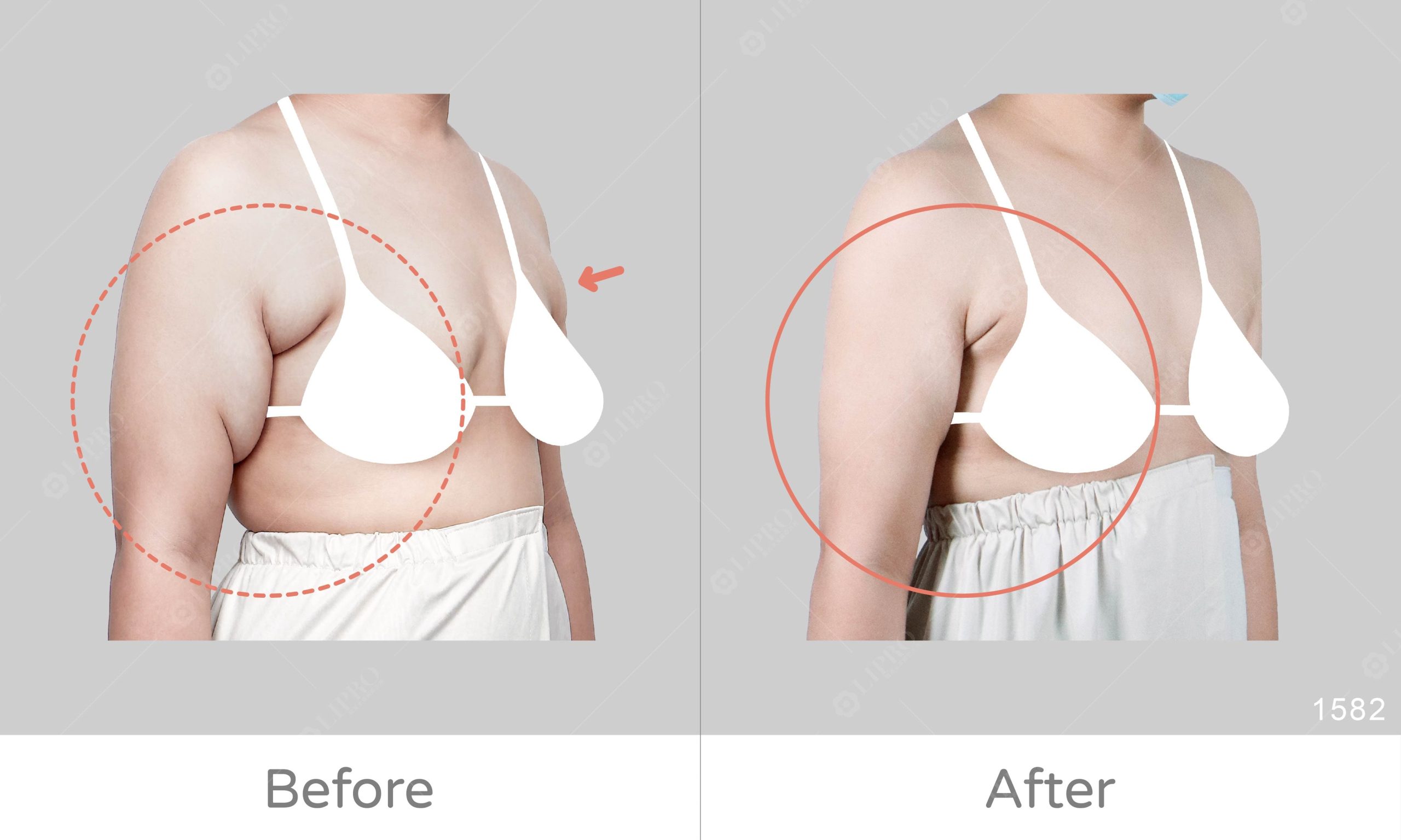麗波永康鬆弛型副乳案例術後見證、不需切皮不須穿塑身衣