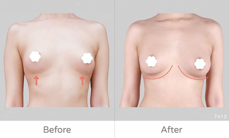 自體豐胸案例BA、麗波永康國際診所豐胸手術評價