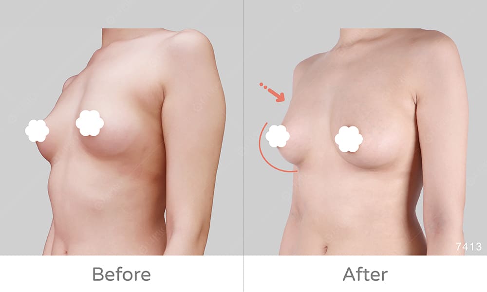 顯微套管豐胸案例好評見證，術前術後差異對比示意圖
