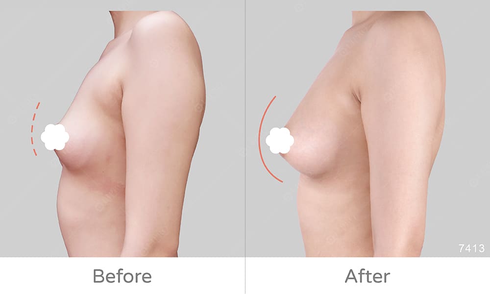 顯微套管豐胸案例好評見證，手術後成效與術前的對比示意圖