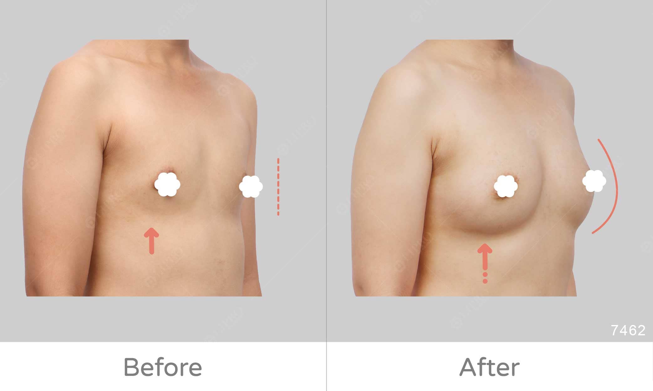 顯微套管自體脂肪移植豐胸案例術後成效見證，豐胸評價好評分享