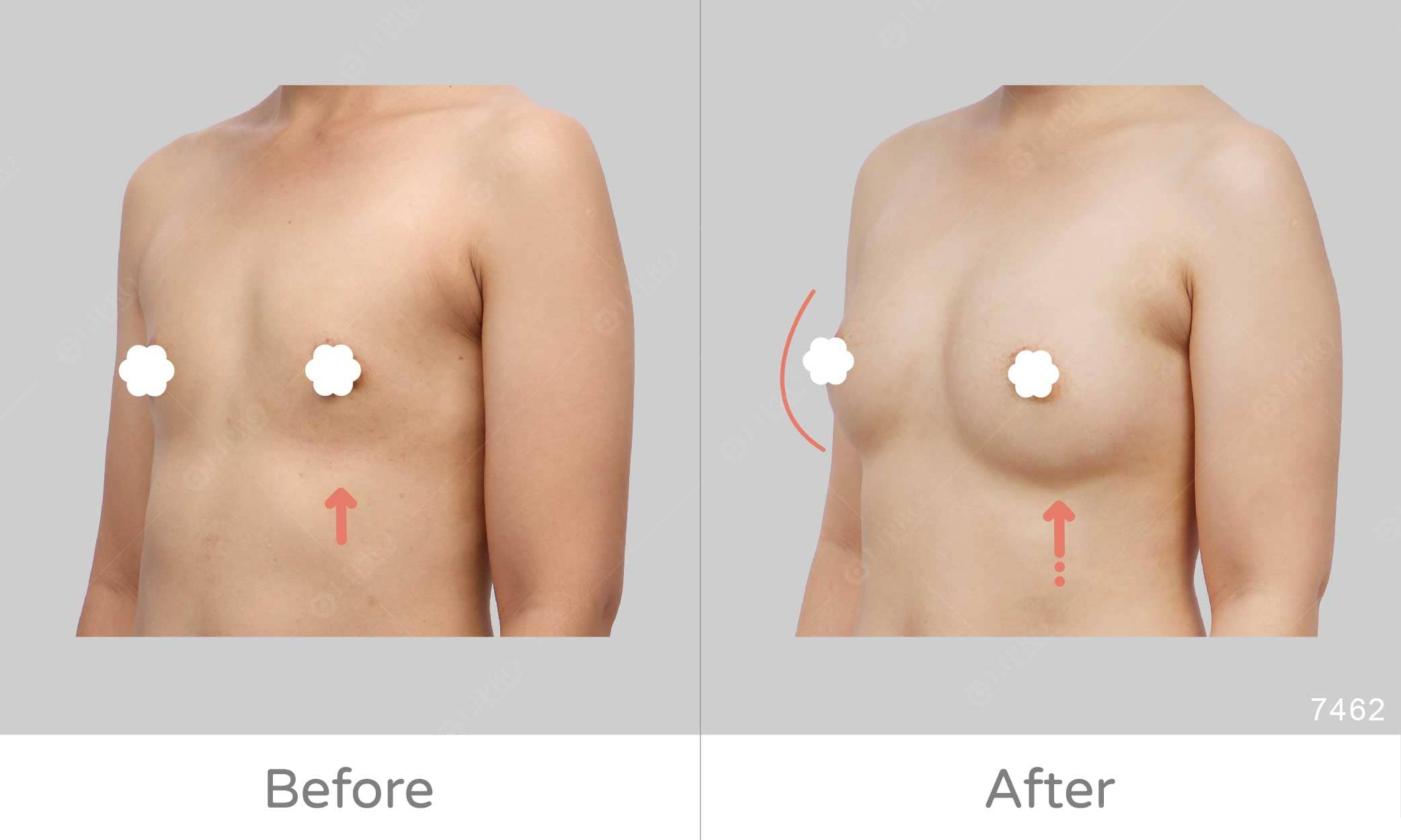 個案先天胸部條件較不足，經過麗波團隊全方位的協助，達到超乎個案預期的胸部補脂案例
