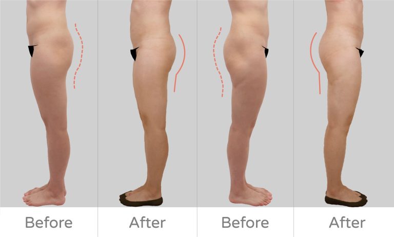 臀部抽脂案例分享，抽脂專家李咏馨醫師精緻調整臀部比例