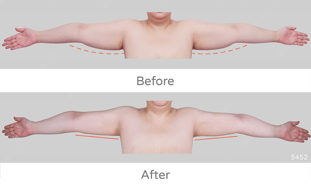 手臂抽脂個案案例分析：手臂皮膚收縮案例、術後自信心大增
