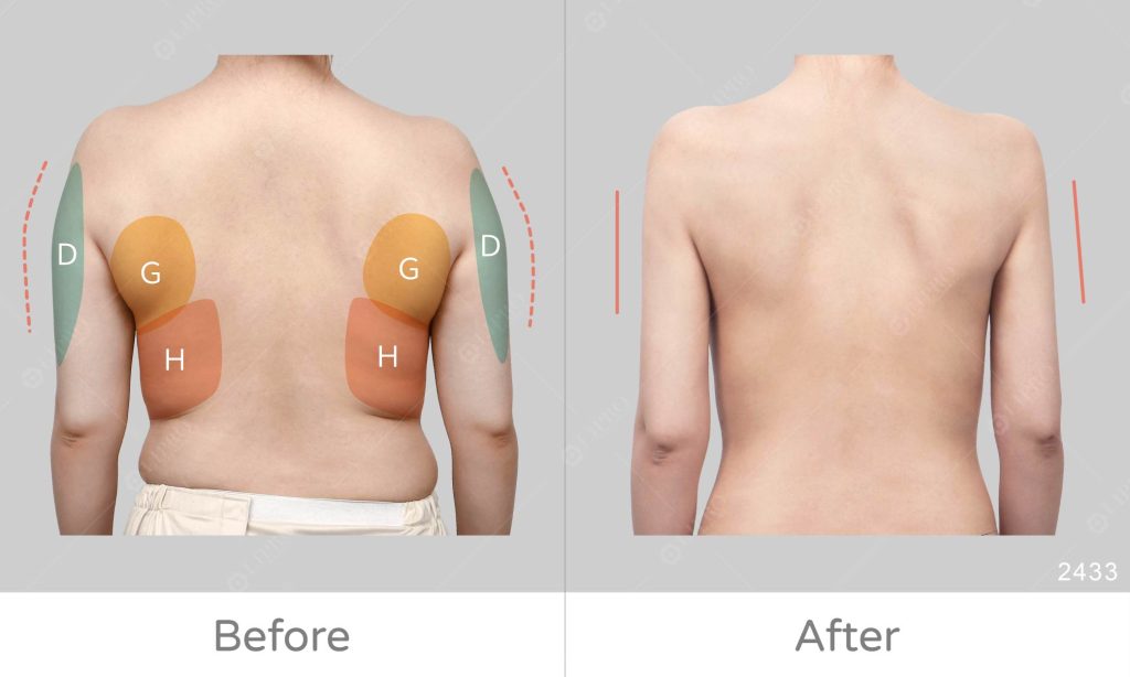 以此案例為範例，精緻的手臂抽脂必須要兼顧手臂外側、後副乳及後背曲線