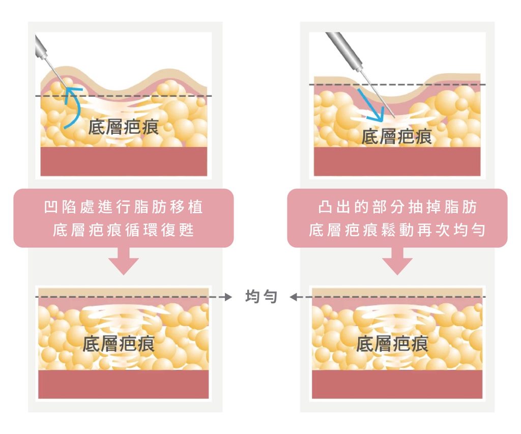 凹凸修復秘密，針對突出及凹陷的區塊有不同的治療方式