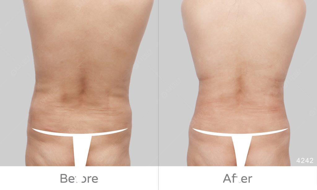 腰腹抽脂手術案例、背面角度展示腰腹抽脂成效