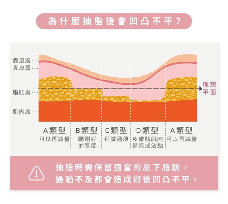 導致抽脂凹凸不平的原因，是不均勻的皮下脂肪層。抽脂時須保留適當的皮下脂肪，過猶不及都會造成術後凹凸不平的情況