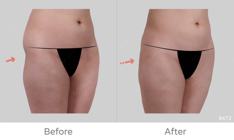臀部補脂案例分享，麗波永康精緻補脂、臀部曲線更平順