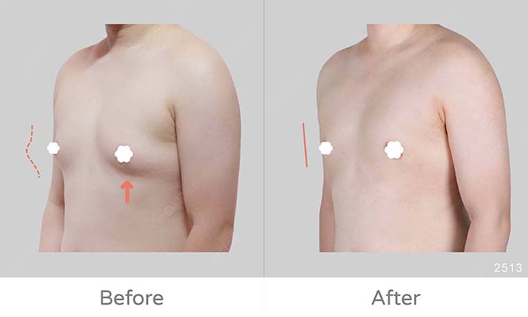 脂肪型男乳的治療案例分享，胸型改變成效明顯