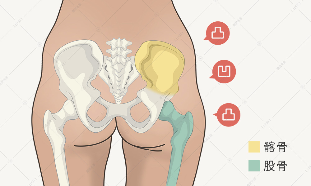 亞洲人常見的先天臀部凹陷，可以用脂肪做改善