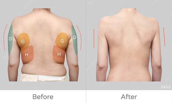 以此案例為範例，精緻的手臂抽脂必須要兼顧手臂外側、後副乳及後背曲線