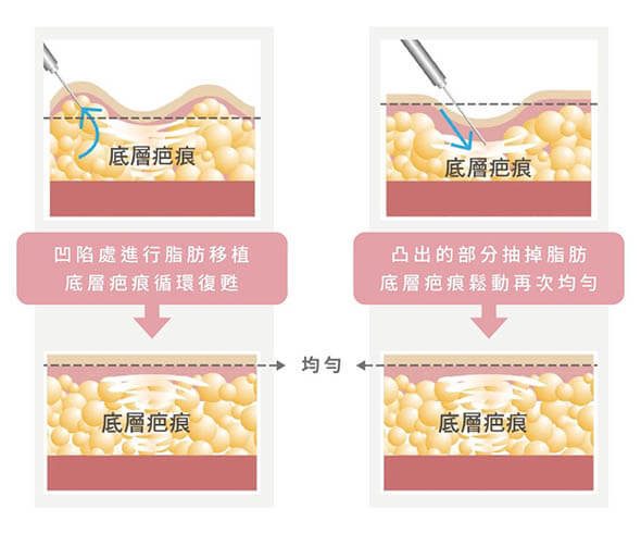抽脂凹凸修復示意圖-16-1024x853_TEST590